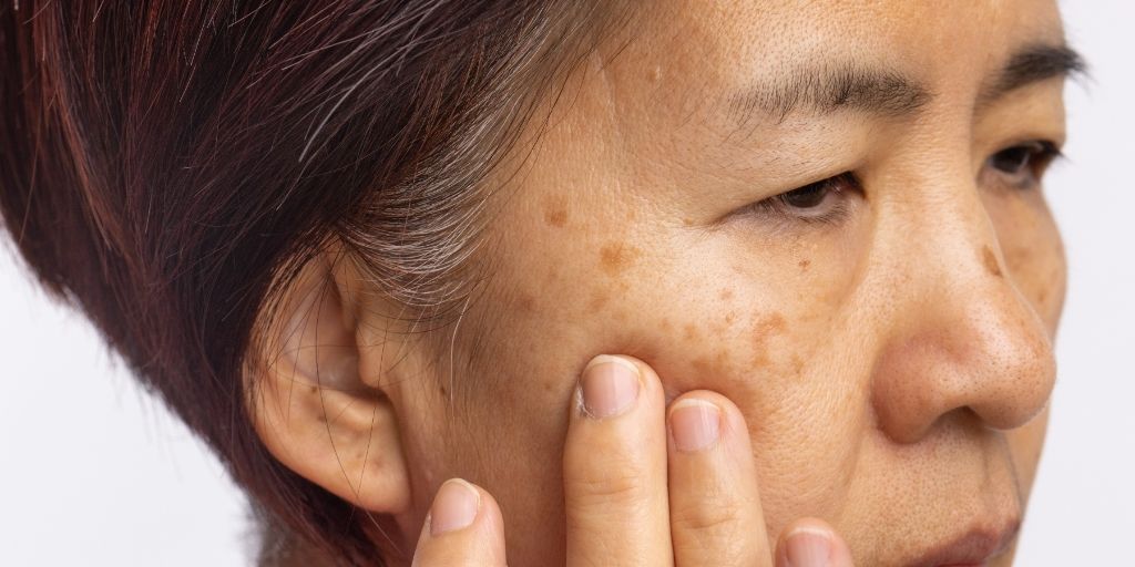 Close-up portrait of a woman with dark hair gently pressing her fingers to her cheek, highlighting visible pigmentation and texture.