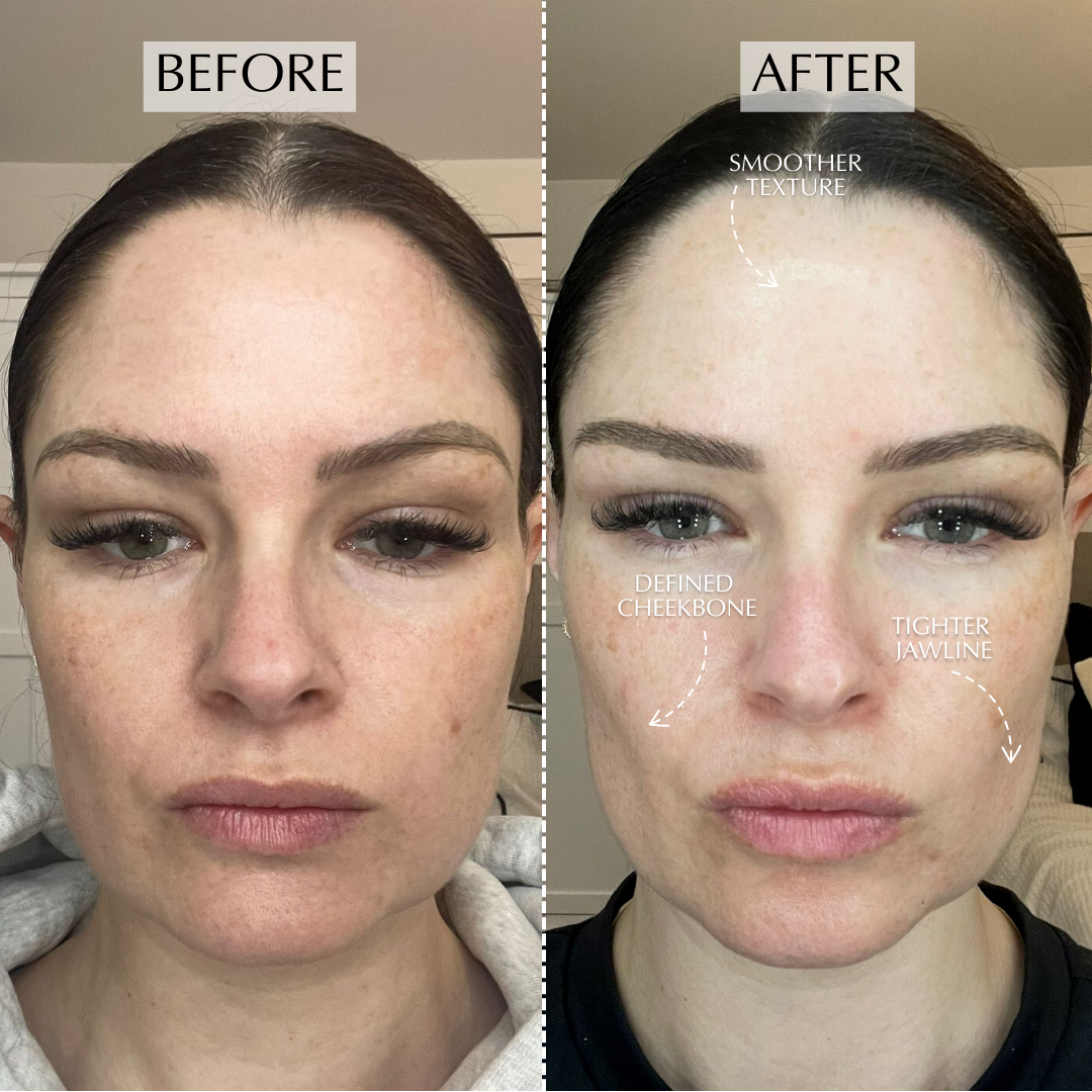 ZIIP HALO Microcurrent Facial Device ZIIP ziip-halo-microcurrent-facial-device-ziip